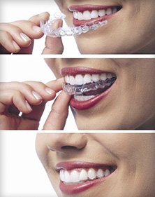 Invisalign invisible braces helps patients in Burlingame, Millbrae, and San Bruno, CA get straight teeth.