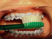 Close up scan of teeth with Wire Braces being brushed with a toothbrush.