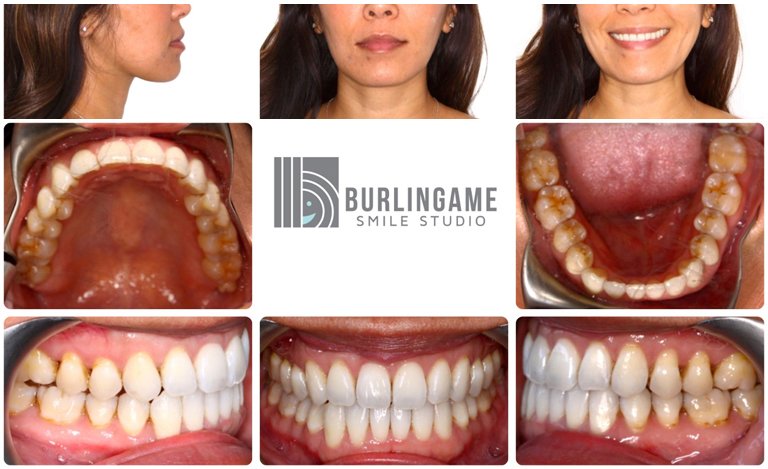 Why Does an Overbite Need to Be Fixed? - Burlingame Smile Studio