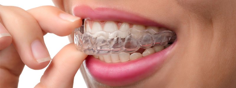 A woman pulling Invisalign tray from her mouth.