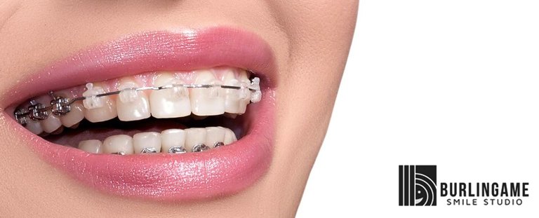 Ceramic Braces Adelaide - Clear Orthodontics - Orthodontic Smile Practice