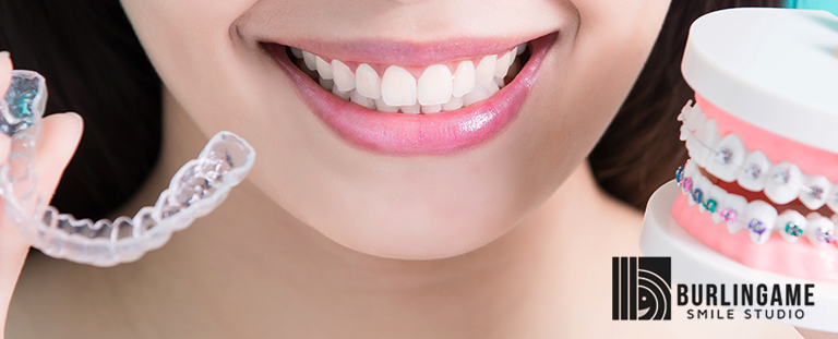 Why Does an Overbite Need to Be Fixed? - Burlingame Smile Studio