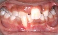 Anterior crossbite in Burlingame