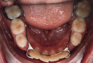 Orthodontic appliance being applied to a Millbrae patient's teeth.