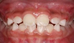 Open bite repair in Burlingam, CA - After