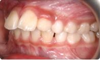 Patient who would like to learn how to fix an overbite consults with Dr. Lee in Burlingame.