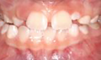 Posterior crossbite in Burlingame