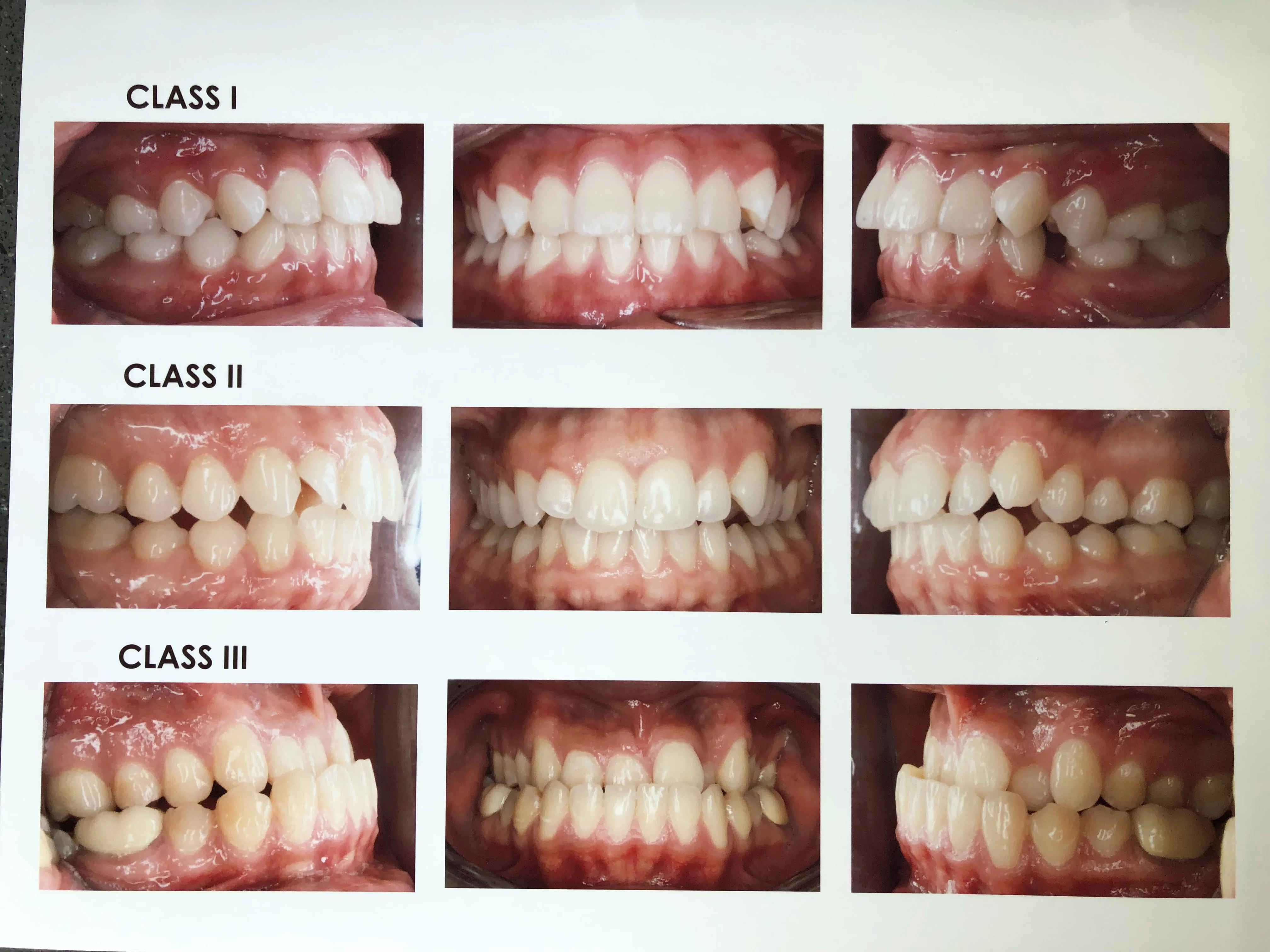 Types of orthodontic bite problems including overbite, underbite, crossbite, open bite, crowding and spacing
