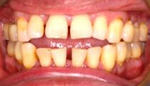 Widely spaced teeth in need of corrective orthodontics in Burlingame.