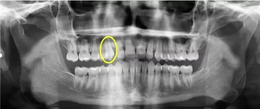 Impacted teeth after receiving orthodontic treatment in Burlingame.