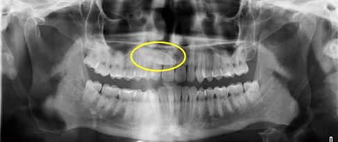 Impacted teeth before receiving orthodontic treatment in Burlingame.