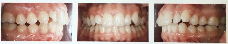 Example of class II maloccluision in Burlingame, CA