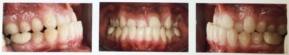 Example of class III malocclusion in Burlingame, CA