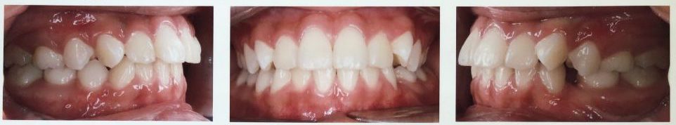 example of class I malocclusion in Burlingame, CA