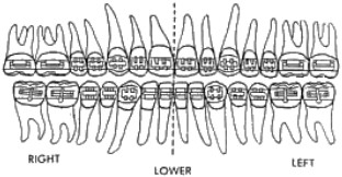 diagram of teeth divided in two down the middle to show where elastics would go