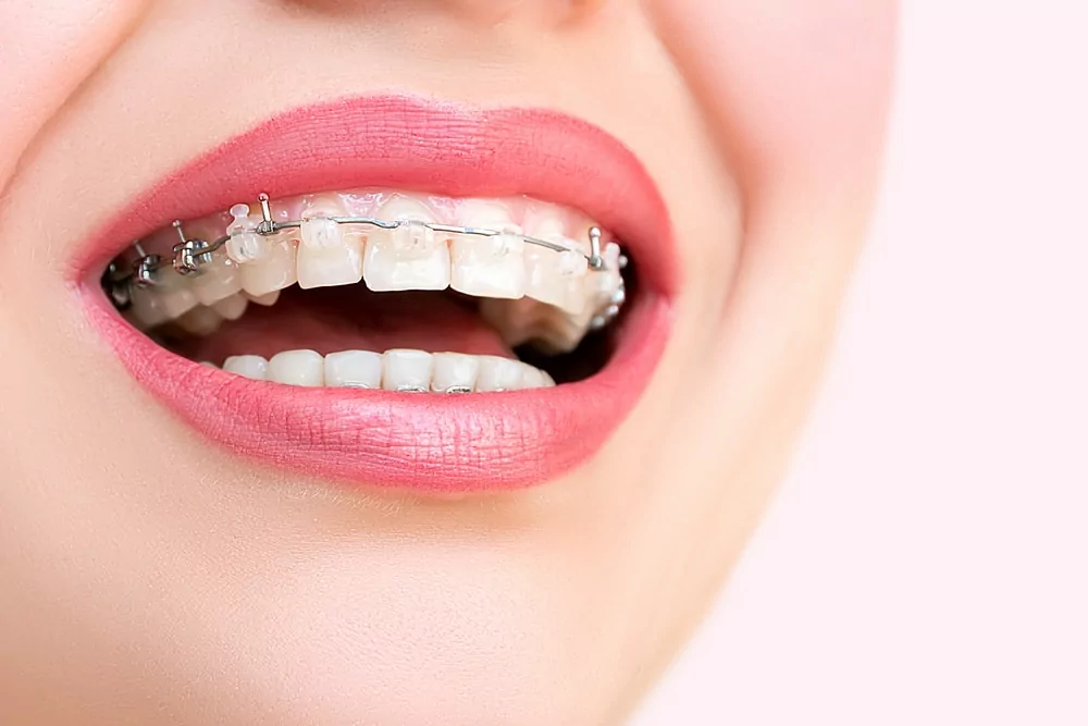 Self-Ligating Braces: Pros and Cons - Burlingame Smile Studio