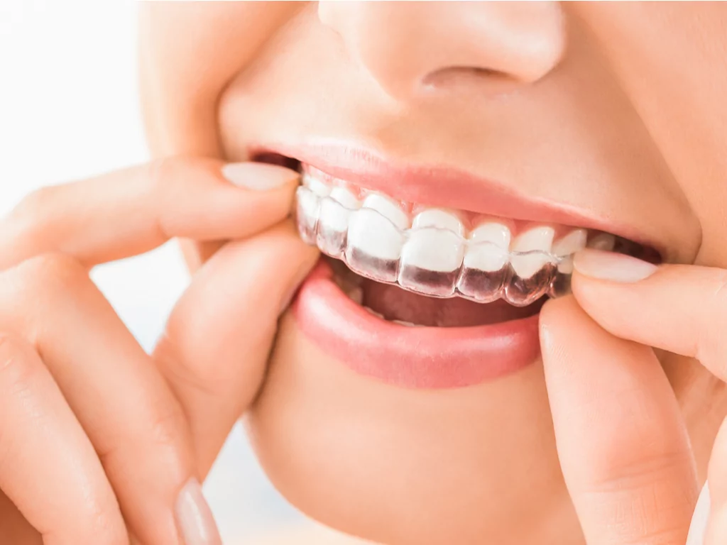 Phases of Orthodontic Treatment in Burlingame.