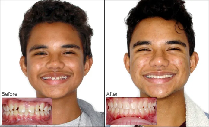 Real patient before and after orthodontics in Burlingame smile photos